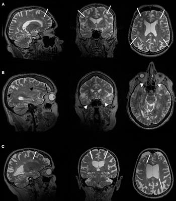 Current Progress in CNS Imaging of Myotonic Dystrophy